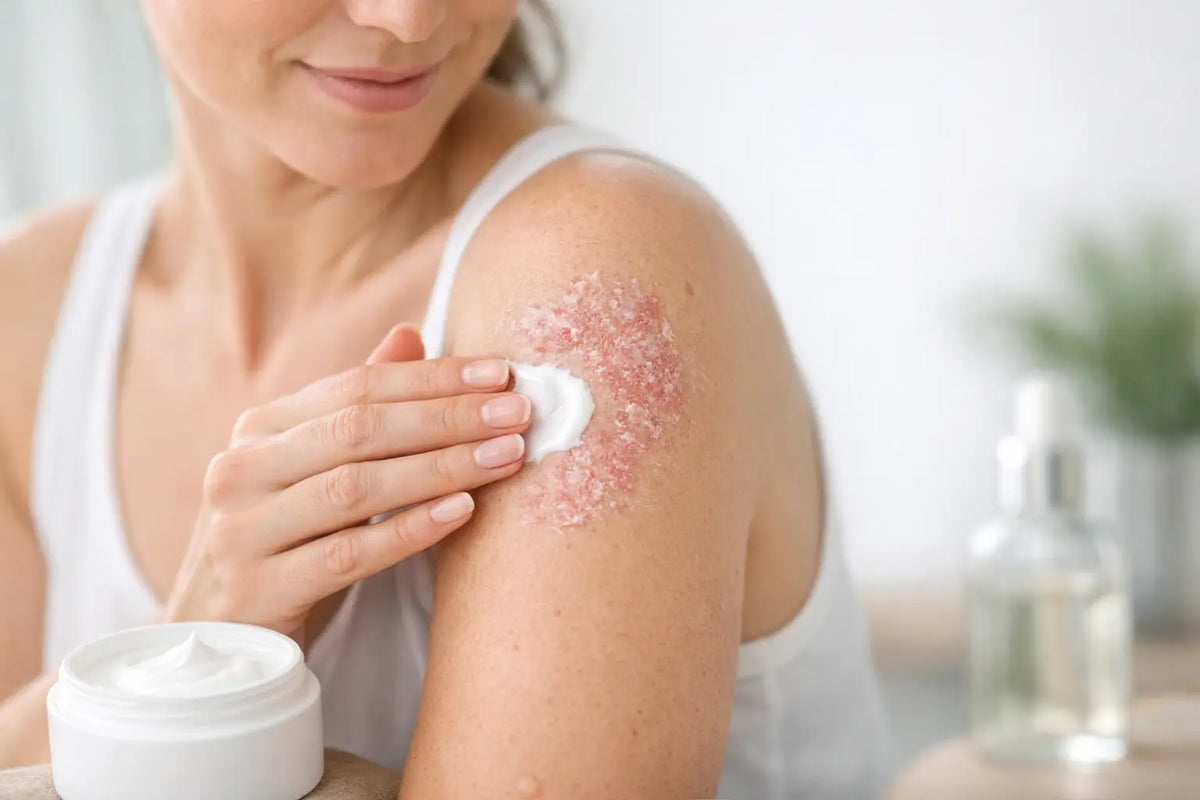 How to Hydrate Psoriasis Skin Without Overdoing It
