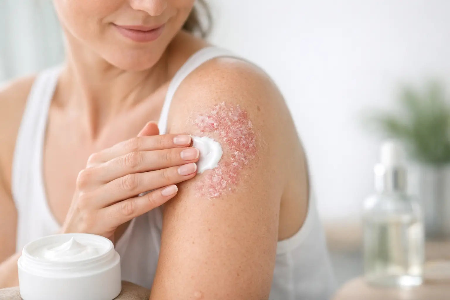 How to Hydrate Psoriasis Skin Without Overdoing It