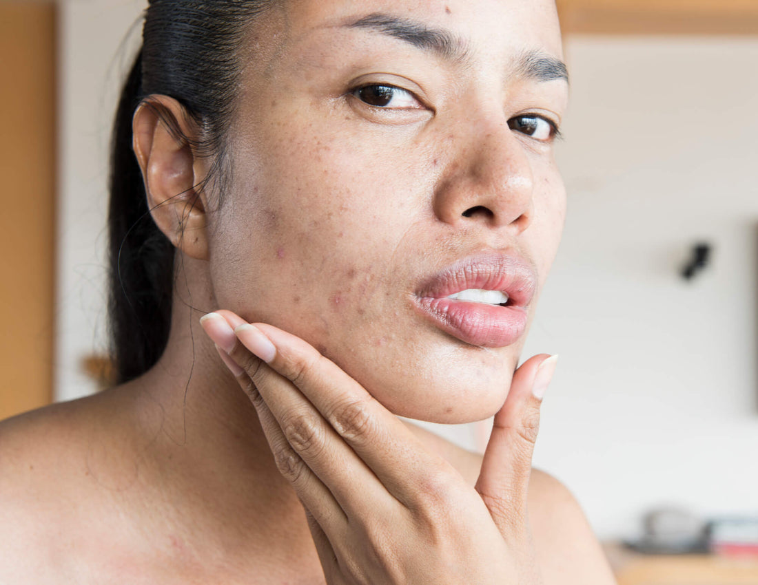 Could the Root Cause of Your Acne Actually Be Dry Skin?
