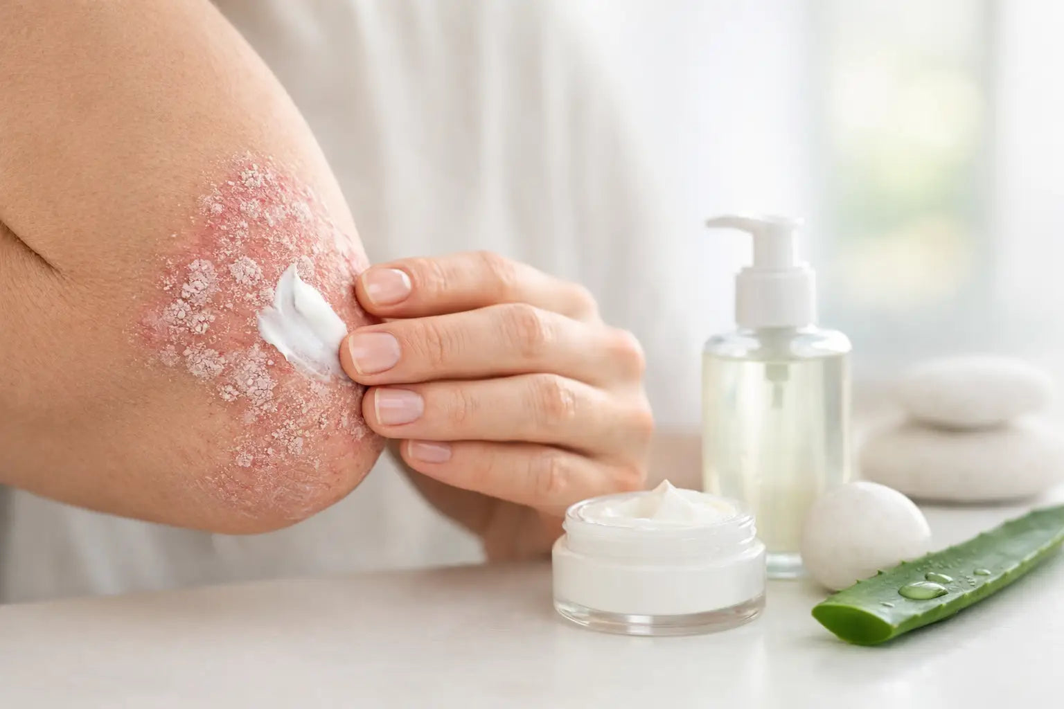Psoriasis Dry Skin Relief for a Stronger Barrier