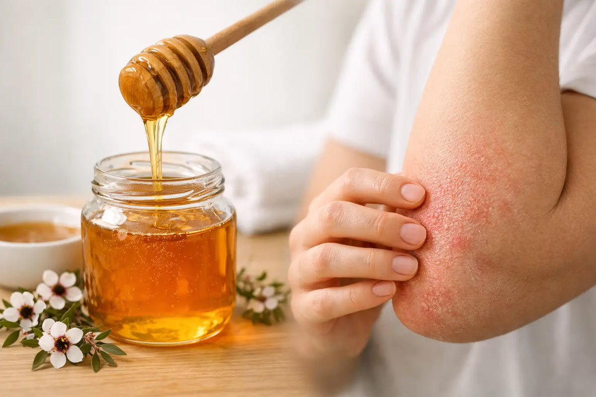Is Manuka Honey Good for Eczema? What Helps