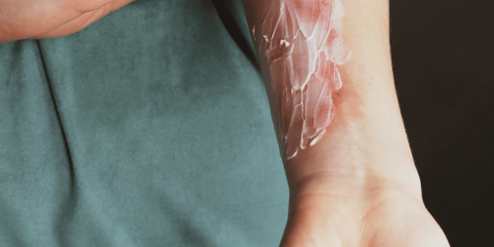 Why Your Topical Steroids Might Be Secretly Damaging Your Skin