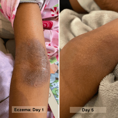 eczema on a 9 year old leg and 5 days after using the honey salve