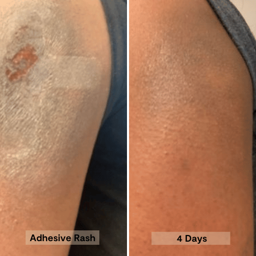 Honey Salve results after 4 days using it on an adhesive rash