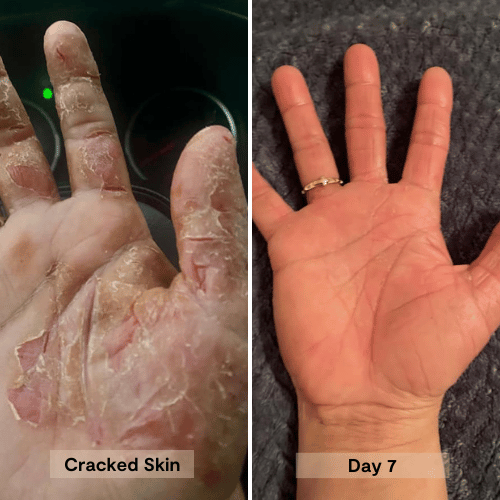 using the salve on cracked, dry hands and 7 days after