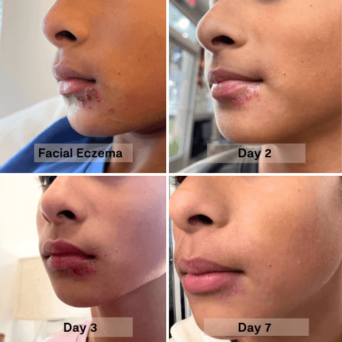 7 days using the honey salve on a child's facial eczema