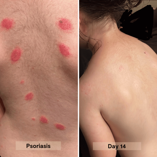 psoriasis on 14 year old, and results using the salve for 14 days after